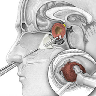 جراحی اندوسکوپی تومور هیپوفیز مغز