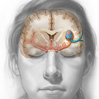 جراحی ضایعات عروقی مغز