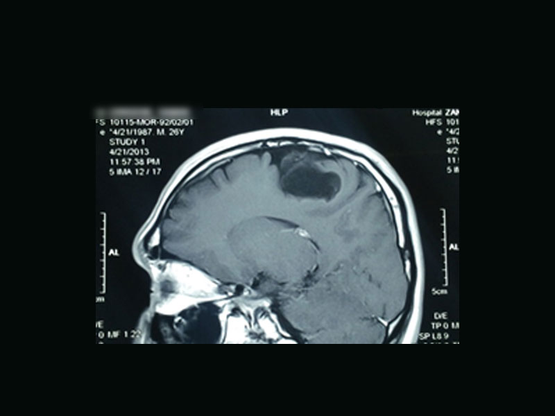 جراحی تومورخوش خیم مغز